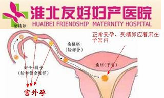 宫外孕,你忽视了吗